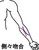 側々吻合イラスト